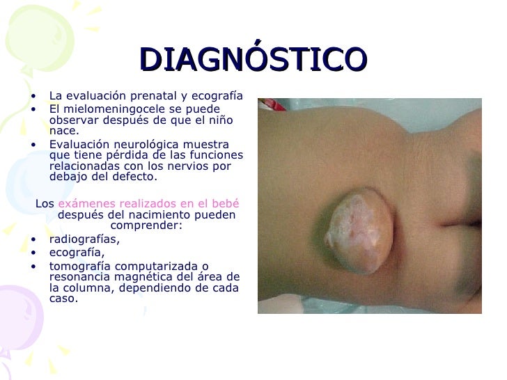 disrafias espinales